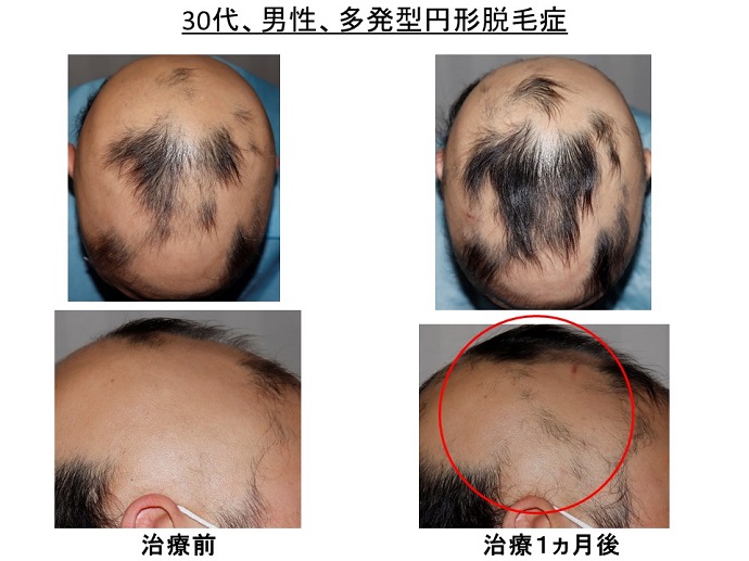 円形脱毛症　病院
